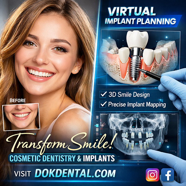Dental Implants